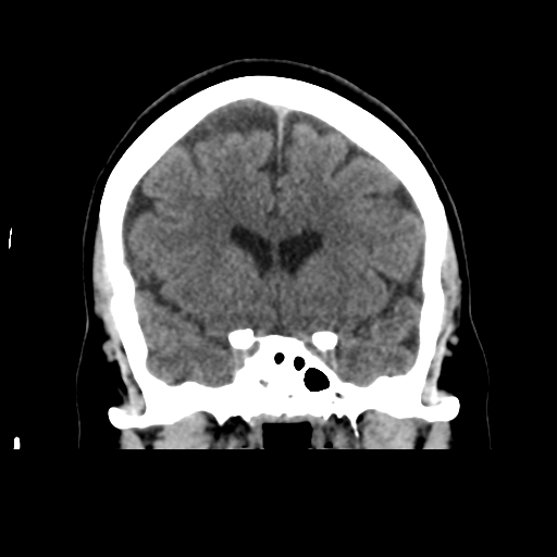 Cerebellar metastasis (cystic appearance) (Radiopaedia 41395-44258 Coronal non-contrast 25).png