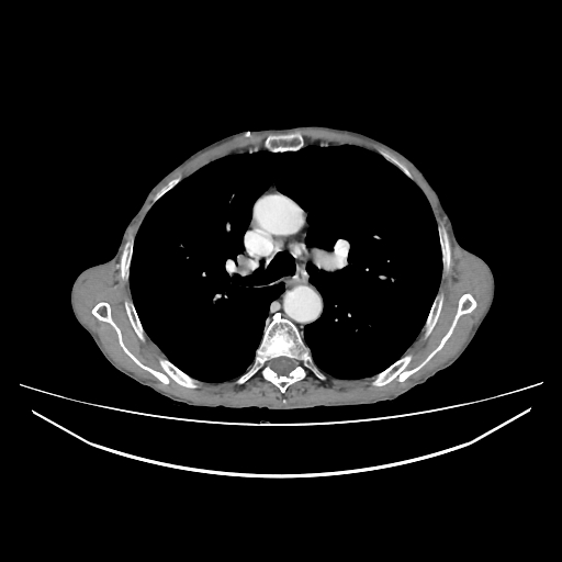 File:Cerebellar metastasis - lung tumor (Radiopaedia 69317-79150 A 13).jpg