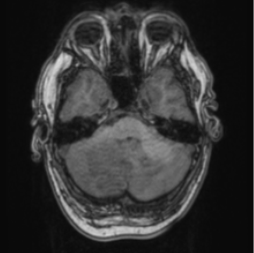 Cerebellar metastasis from lung adenocarcinoma (Radiopaedia 86690-102829 Axial T1 22).png
