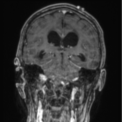 Cerebellar metastasis from lung adenocarcinoma (Radiopaedia 86690-102829 Coronal T1 C+ 45).png