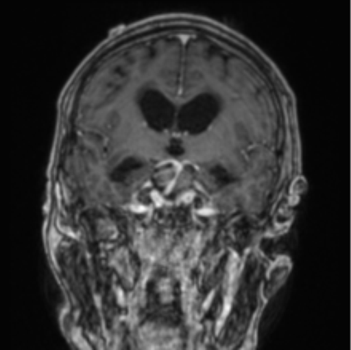 Cerebellar metastasis from lung adenocarcinoma (Radiopaedia 86690-102829 Coronal T1 C+ 55).png