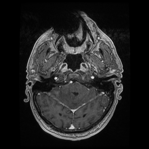 Cerebellar metastasis of pulmonary adenocarcinoma, cavernous venous malformation, and developmental venous anomaly (Radiopaedia 85827-101661 Axial T1 C+ 31).jpg