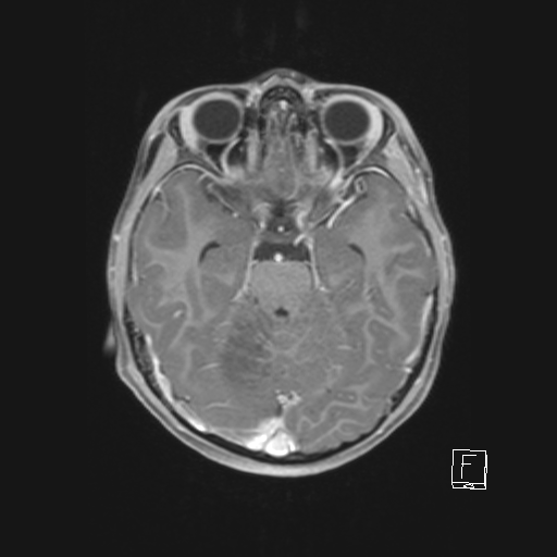 Cerebellar stroke (Radiopaedia 32202-33150 Axial T1 C+ 31).png