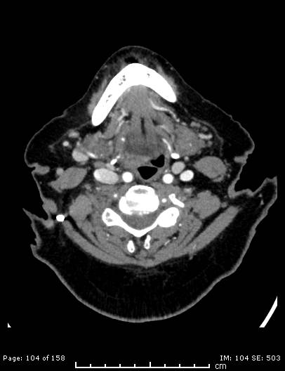 Cerebellar strokes due to intracranial giant cell arteritis (Radiopaedia 68799-78510 CT angiogram 104).jpg