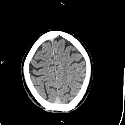 Cerebellopontine angle arachnoid cyst (Radiopaedia 85149-100704 Axial With contrast 42).jpg