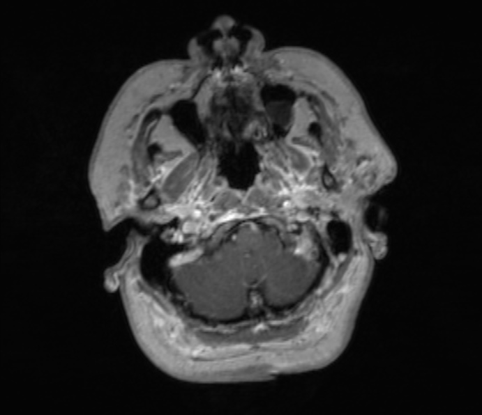 Cerebellopontine angle meningioma (Radiopaedia 35181-36715 Axial T1 C+ 48).jpg