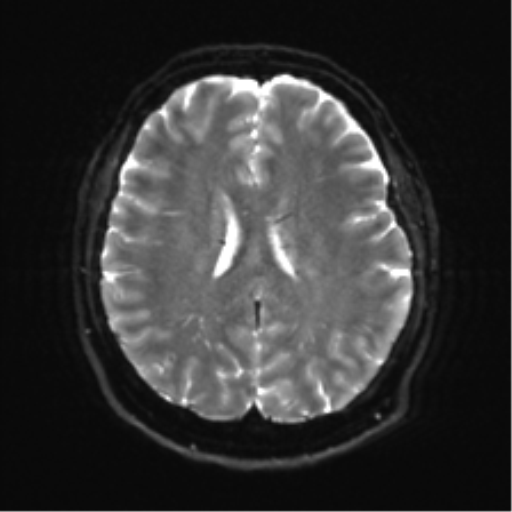 Cerebellopontine angle meningioma (Radiopaedia 48434-53348 Axial DWI 25).png