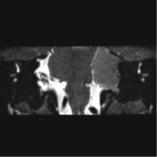 File:Cerebellopontine angle meningioma (Radiopaedia 48434-53348 Coronal T2 44).png
