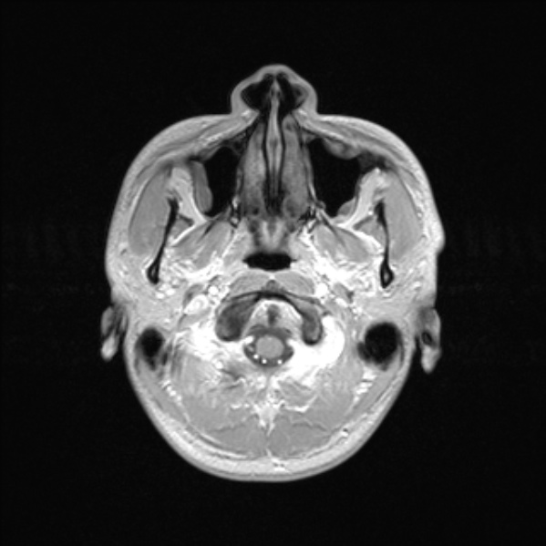 Cerebral abscess (Radiopaedia 24212-24478 Axial T1 C+ 9).jpg