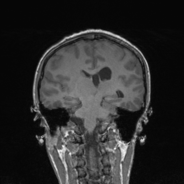 Cerebral abscess (Radiopaedia 24212-24478 Coronal T1 126).jpg