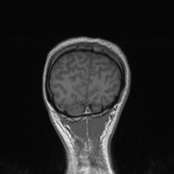 Cerebral abscess (Radiopaedia 24212-24478 Coronal T1 175).jpg