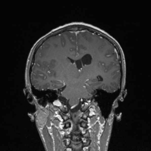 File:Cerebral abscess (Radiopaedia 24212-24478 Coronal T1 C+ 124).jpg