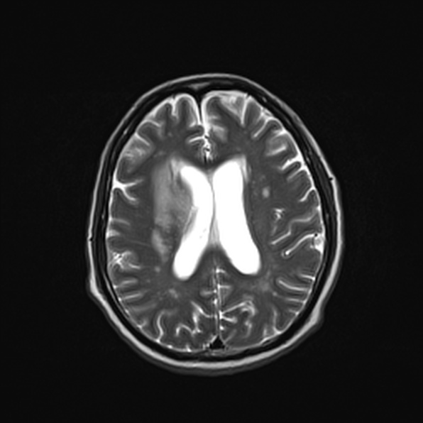 Cerebral abscess (Radiopaedia 26111-26247 Axial T2 39).jpg
