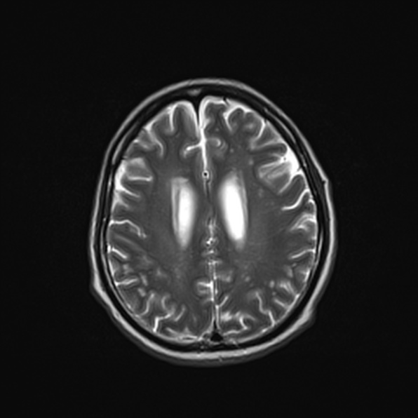 Cerebral abscess (Radiopaedia 26111-26247 Axial T2 42).jpg