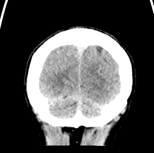 File:Cerebral abscess (Radiopaedia 60342-68008 Coronal non-contrast 57).png