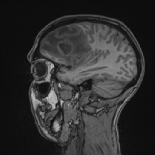 Cerebral abscess (Radiopaedia 60342-68009 Sagittal T1 41).png