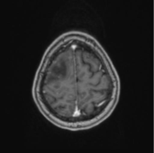Cerebral abscess from pulmonary arteriovenous malformation (Radiopaedia 86275-102291 Axial T1 C+ 64).png