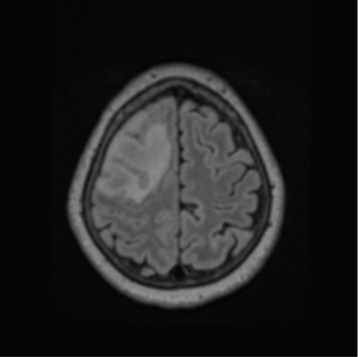 File:Cerebral abscess from pulmonary arteriovenous malformation (Radiopaedia 86275-102291 J 61).png