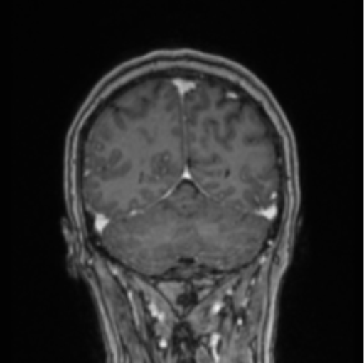 Cerebral abscess from pulmonary arteriovenous malformation (Radiopaedia 86275-102291 L 25).png