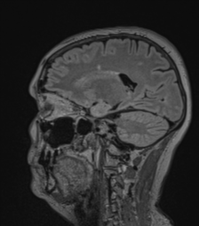 Cerebral abscess from pulmonary arteriovenous malformation (Radiopaedia 86275-102291 Sagittal FLAIR 29).png