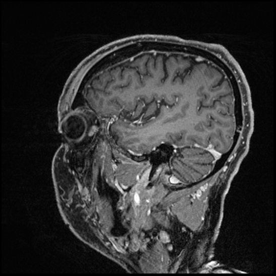 Cerebral abscess with ventriculitis (Radiopaedia 78965-91878 Sagittal T1 C+ 47).jpg