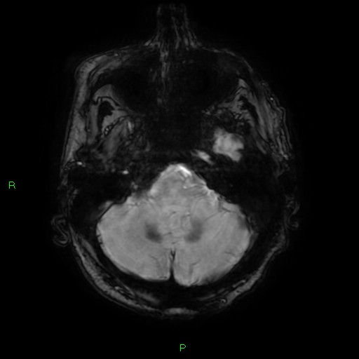 File:Cerebral amyloid angiopathy-associated lobar intracerebral hemorrhage (Radiopaedia 58376-65512 Axial SWI 12).jpg