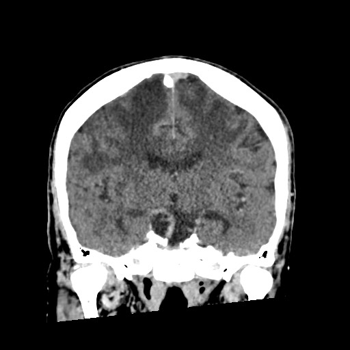 Cerebral amyloid angiopathy-related inflammation (Radiopaedia 74836-85848 Coronal non-contrast 37).jpg