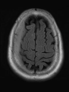 File:Cerebral amyloid angiopathy (Radiopaedia 29129-29518 Axial FLAIR 18).jpg
