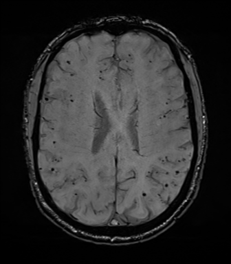 File:Cerebral amyloid angiopathy (Radiopaedia 46082-50433 Axial SWI 53).png