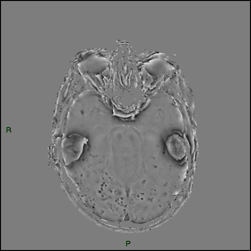 Cerebral amyloid angiopathy (Radiopaedia 77506-89664 H 40).jpg