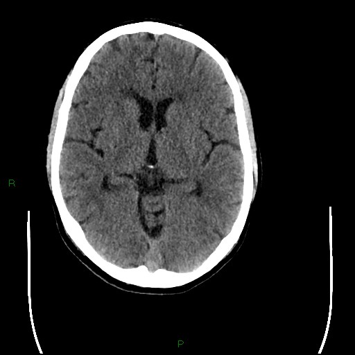 Cerebral amyloid angiopathy (Radiopaedia 77506-89665 Axial non-contrast 52).jpg