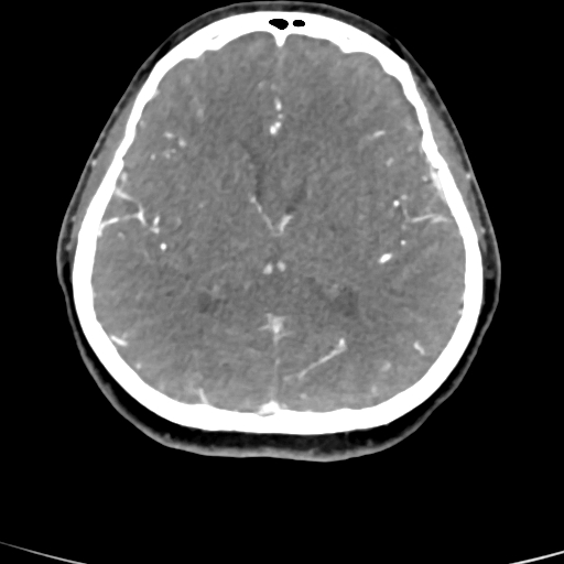 File:Cerebral arteriovenous malformation (Radiopaedia 73830-84645 B 47).jpg