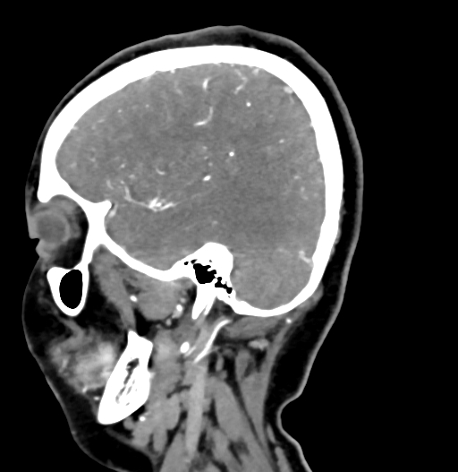 Cerebral arteriovenous malformation (Radiopaedia 73830-84645 D 71).jpg