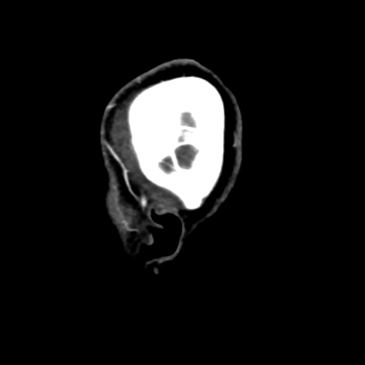 Cerebral arteriovenous malformation (Radiopaedia 73830-84645 Sagittal C+ delayed 3).jpg