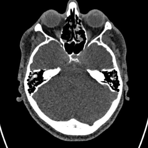 File:Cerebral arteriovenous malformation (Radiopaedia 78188-90746 Axial non-contrast 50).jpg