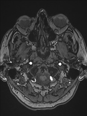 File:Cerebral arteriovenous malformation (Radiopaedia 84015-99245 Axial TOF 48).jpg