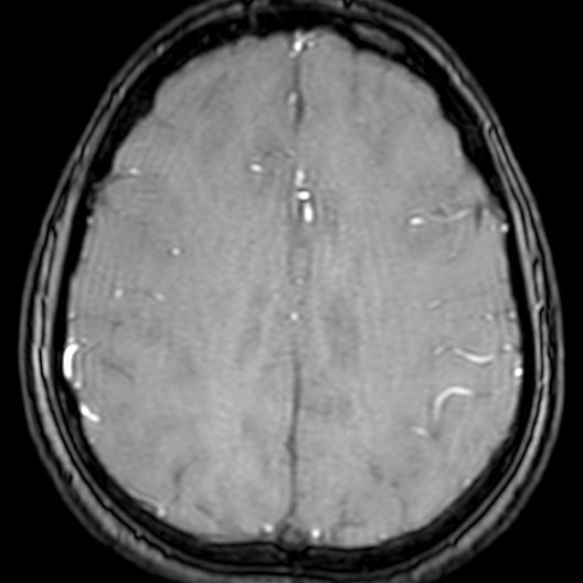 Cerebral arteriovenous malformation at posterior body of corpus callosum (Radiopaedia 74111-84925 Axial MRA 159).jpg