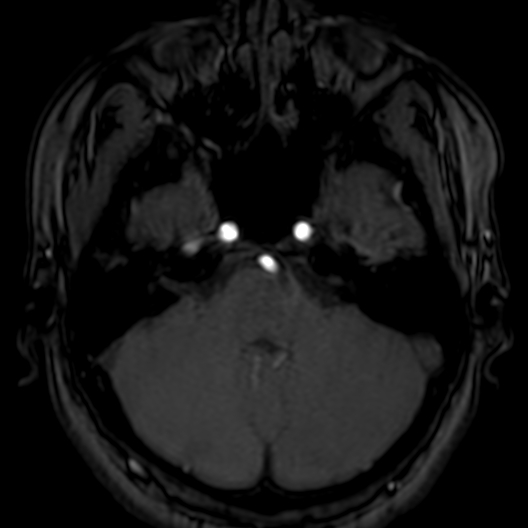 Cerebral arteriovenous malformation at posterior body of corpus callosum (Radiopaedia 74111-84925 Axial MRA 42).jpg