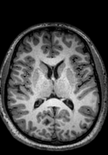 File:Cerebral arteriovenous malformation at posterior body of corpus callosum (Radiopaedia 74111-84925 Axial T1 131).jpg