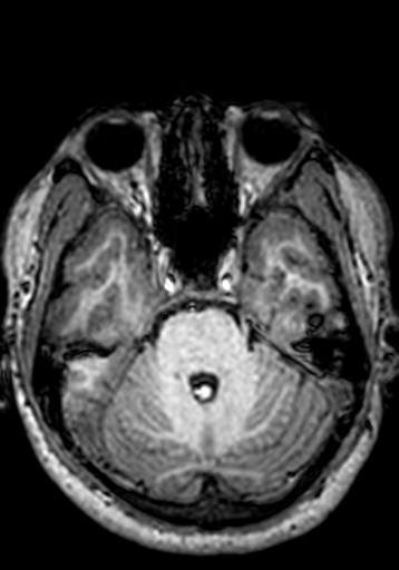 Cerebral arteriovenous malformation at posterior body of corpus callosum (Radiopaedia 74111-84925 Axial T1 222).jpg