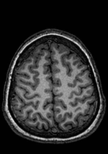 File:Cerebral arteriovenous malformation at posterior body of corpus callosum (Radiopaedia 74111-84925 Axial T1 52).jpg