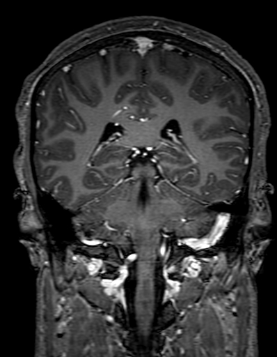 Cerebral arteriovenous malformation at posterior body of corpus callosum (Radiopaedia 74111-84925 K 236).jpg