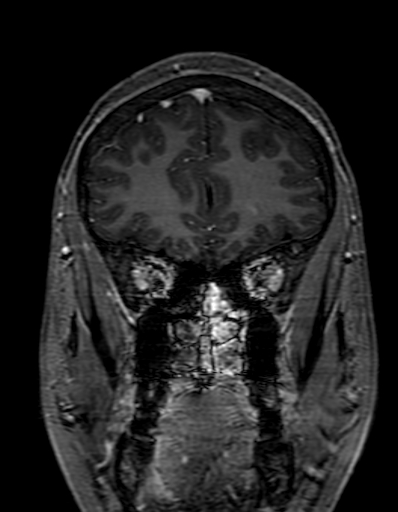 Cerebral arteriovenous malformation at posterior body of corpus callosum (Radiopaedia 74111-84925 K 76).jpg