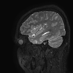 Cerebral arteriovenous malformation at posterior body of corpus callosum (Radiopaedia 74111-84925 Sagittal T2 25).jpg