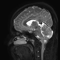 Cerebral arteriovenous malformation at posterior body of corpus callosum (Radiopaedia 74111-84925 Sagittal T2 61).jpg
