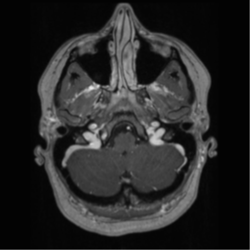Cerebral cavernoma and development venous anomaly (Radiopaedia 37603-39482 Axial T1 C+ 14).png