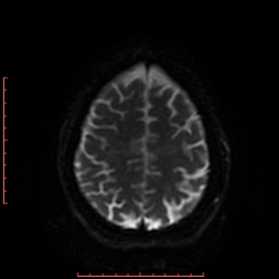File:Cerebral cavernous malformation (Radiopaedia 26177-26306 Axial DWI 37).jpg