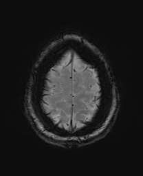 File:Cerebral cavernous venous malformation (Radiopaedia 70008-80021 I 67).jpg