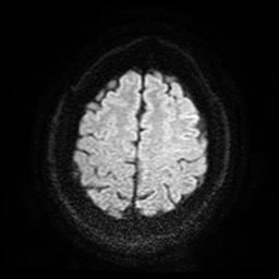 Cerebral cavernous venous malformation (Zabramski type II) (Radiopaedia 85511-101198 Axial DWI 58).jpg