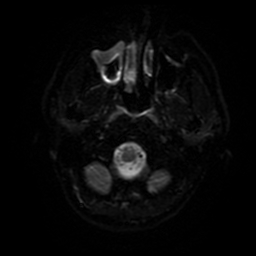 File:Cerebral cavernous venous malformation (Zabramski type II) (Radiopaedia 85511-101198 Axial DWI 70).jpg